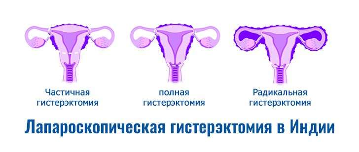 Лапароскопическая гистерэктомия в Индии